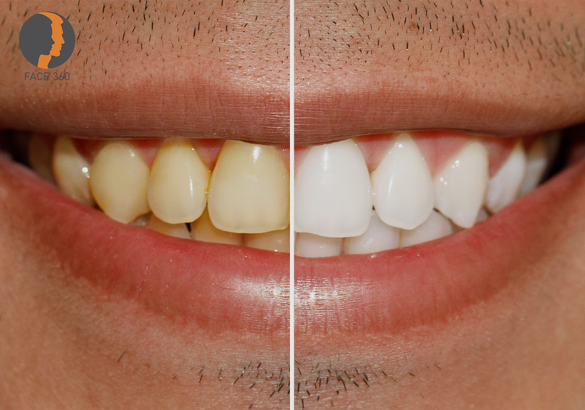 Teeth Before and After Whitening Treatment