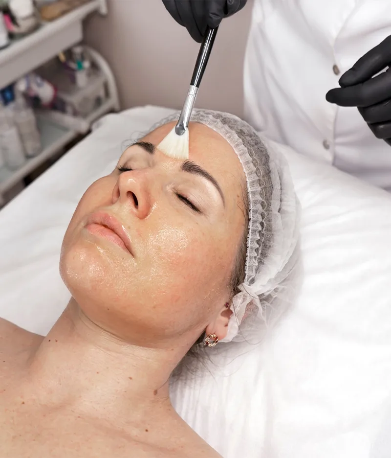 Inno Peel treatment