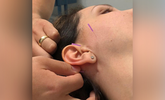 Inno Peel treatment