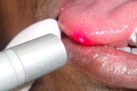 Inno Peel treatment