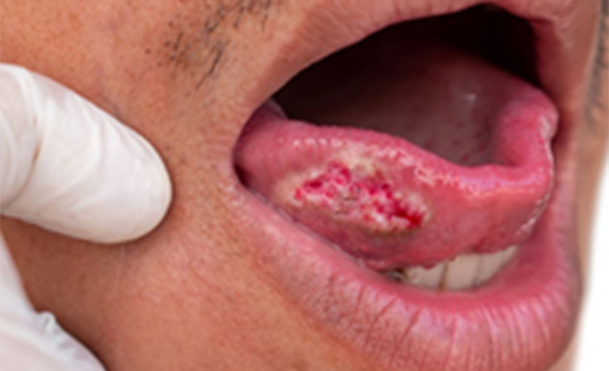 Inno Peel treatment