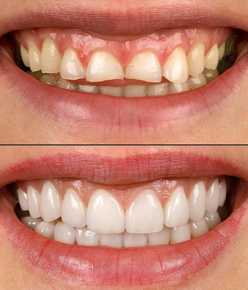 Digital Smile Designing Treatments